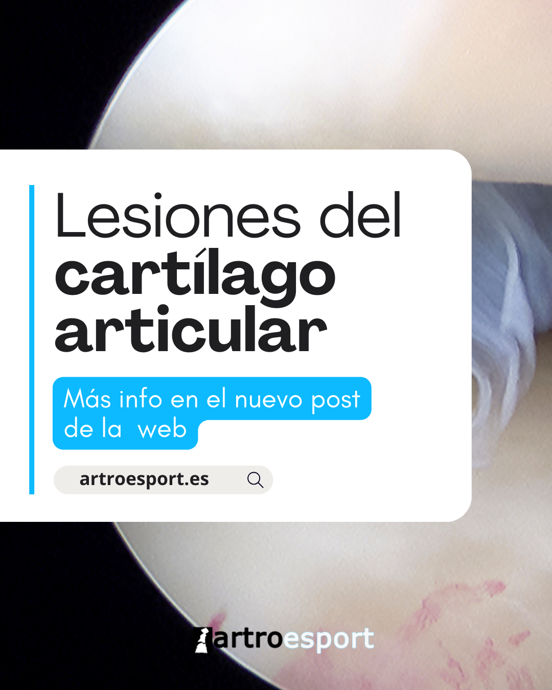 Lesiones del cartílago articular