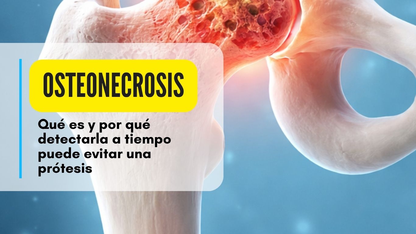 osteonecrosis