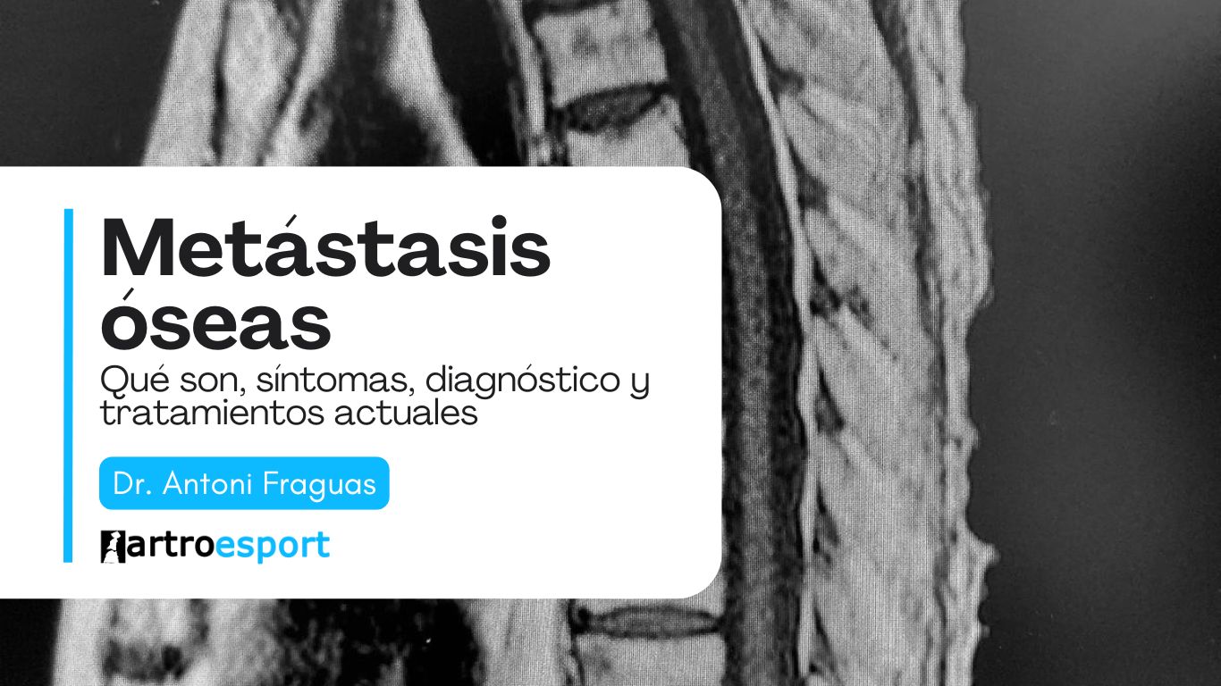 metastasis oseas